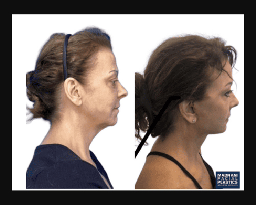 58-year-old Female Deep Plane Facelift Side Profile Photos NYC