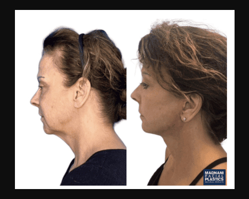 58-year-old Female Deep Plane Facelift Side Profile Photos