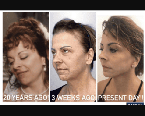 58-year-old Female Deep Plane Facelift Photos