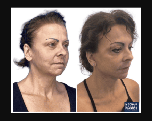 58-year-old Female Deep Plane Facelift Oblique New York City