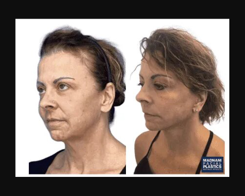 58-year-old Female Deep Plane Facelift Oblique Photos NYC