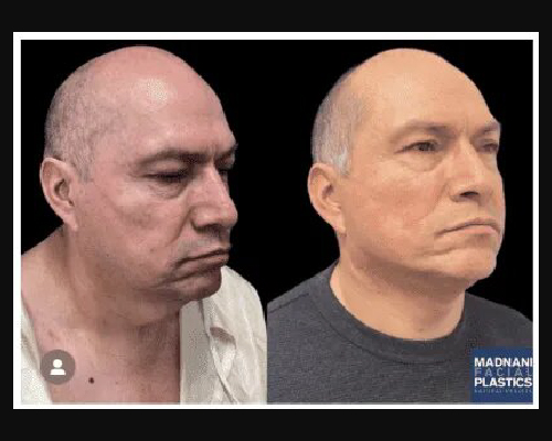 54-year-old Male Deep Plane Facelift Photos NYC