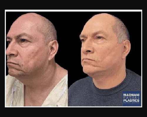 54-year-old Male Deep Plane Facelift Photos