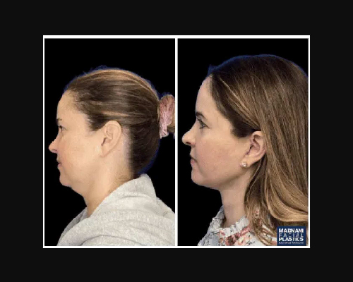 46-year-old Female Deep Plane Facelift Photos