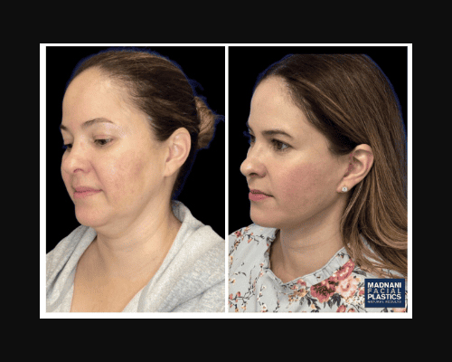 46-year-old Female Deep Plane Facelift Deep plane Neck Lift