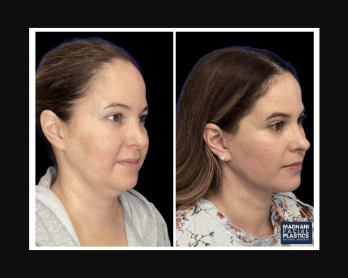 46-year-old female who underwent a Deep Plane Facelift an extended Deep plane Neck Lift