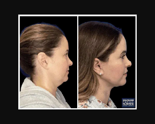 46-year-old Female Deep Plane Facelift Photos NYC