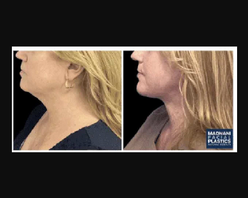 47-year-old Female Facelift Patient Photos New York City