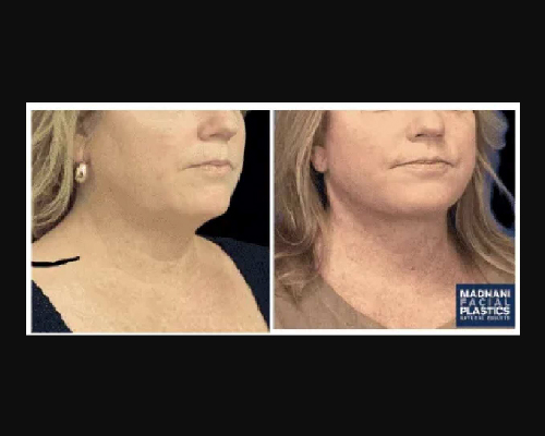 47-year-old Female Facelift Patient Before and After Photos