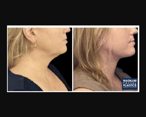 47-year-old Female Facelift Patient Photos