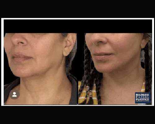 Deep Plane Facelift Extended Deep plane Neck Lift Before and After NYC