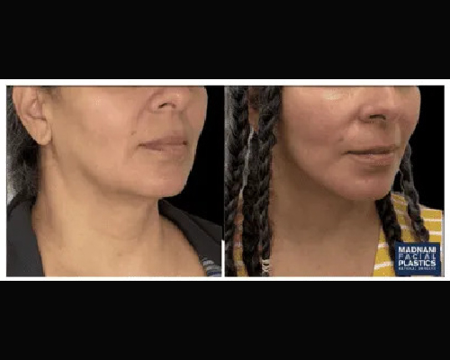 Deep Plane Facelift and extended Deep plane Neck Lift