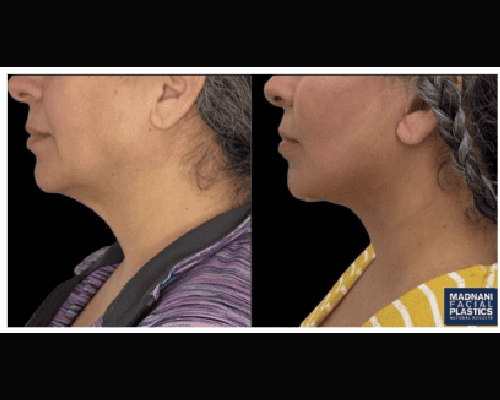 Deep Plane Facelift and extended Deep plane Neck Lift Before and After