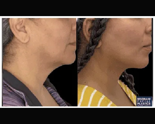 Deep Plane Facelift Extended Deep plane Neck Lift Before and After