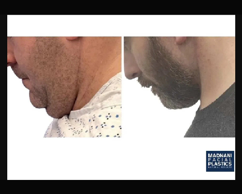 42-year-old Male Extended Deep Plane Face and Necklift Side Profile Photos