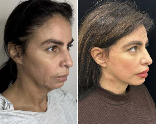 50-year-old Female Before and After Facelift Results