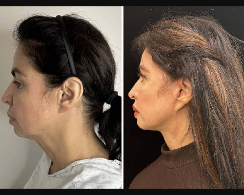 50-year-old Female Before and After Facelift Photos