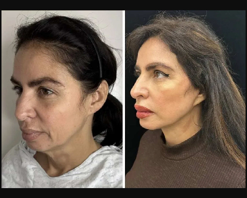 50-year-old Female Before and After Facelift Oblique View