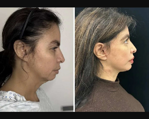 50-year-old Female Before and After Facelift Side View