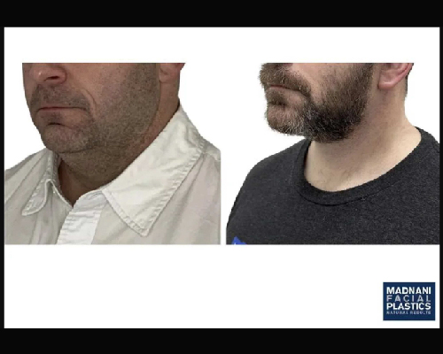 42-year-old Male Extended Deep Plane Face and Necklift NYC