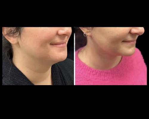 36-year-old Female Extended Necklift Photos NYC