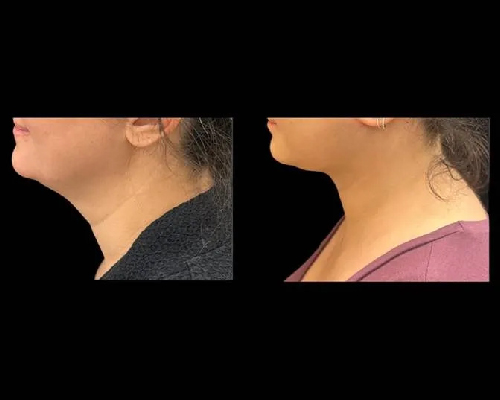 36-year-old Female Extended Necklift Before and After