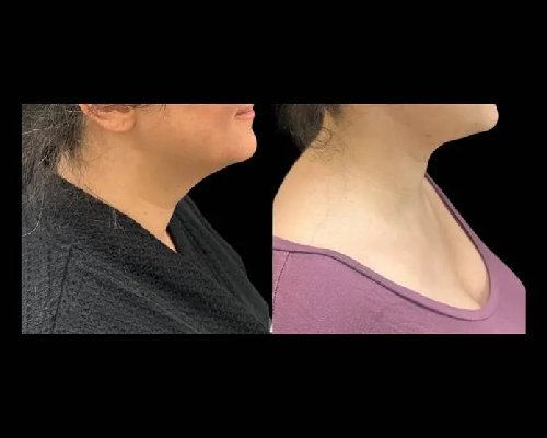 36-year-old Female Extended Necklift Photos