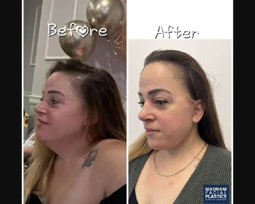 48-year-old Facelift Patient Before and After Photos