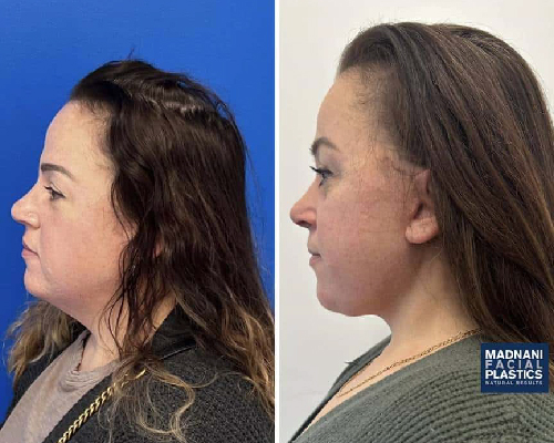 48-year-old Facelift Patient Photos