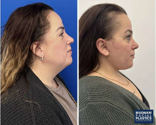 48-year-old Facelift Patient Before and After Side Profile