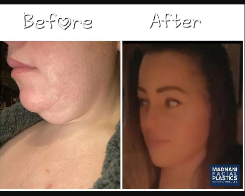 48-year-old Facelift Patient Before and After Results