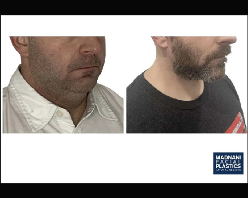 42-year-old Male Extended Deep Plane Face and Neck Lift NYC