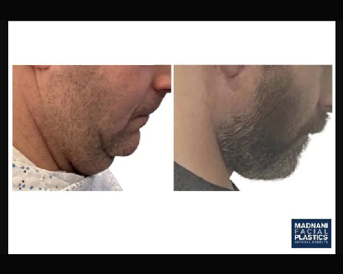 42-year-old Male Extended Deep Plane Face and Necklift Photos