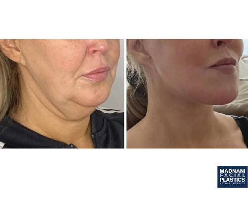 46-year-old Female Face and Necklift New York