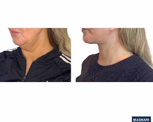 46-year-old Female Face and Necklift NYC