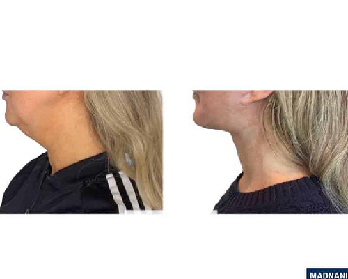 46-year-old Female Face and Necklift Photos