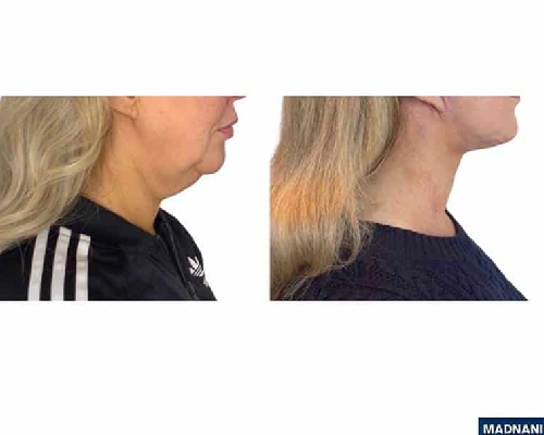 46-year-old Female Face and Necklift