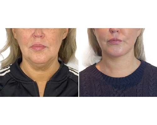 46-year-old Female Face and Necklift Results