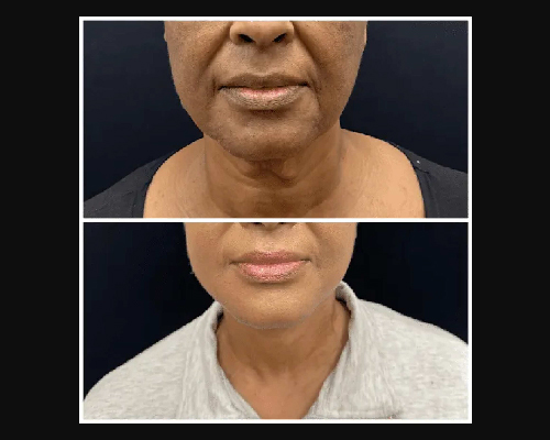 56-year-old Deep Plane Facelift Patient Photos Front View