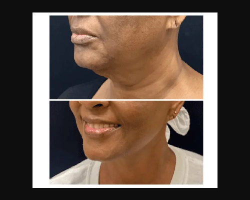 56-year-old Deep Plane Facelift Patient Photos New York City