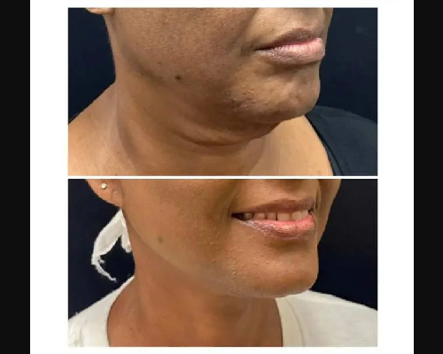 56-year-old Deep Plane Facelift Patient Photos