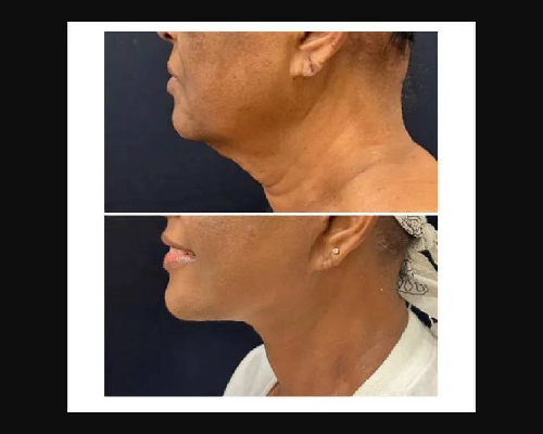 56-year-old Deep Plane Facelift Patient Photos Side View