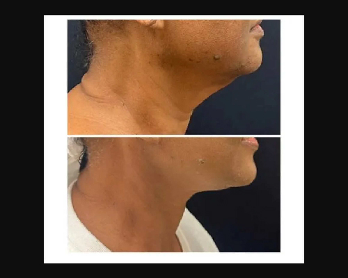 56-year-old Deep Plane Facelift Patient Photos NYC