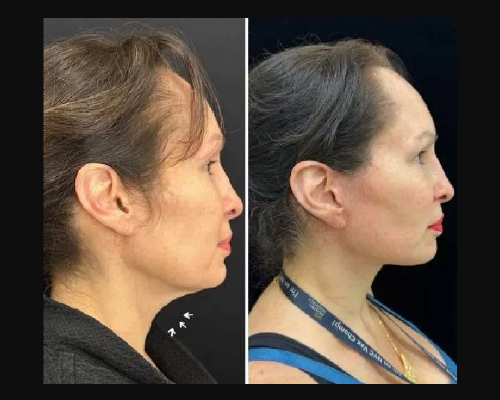 50-year-old Female Awake Facelift Side View