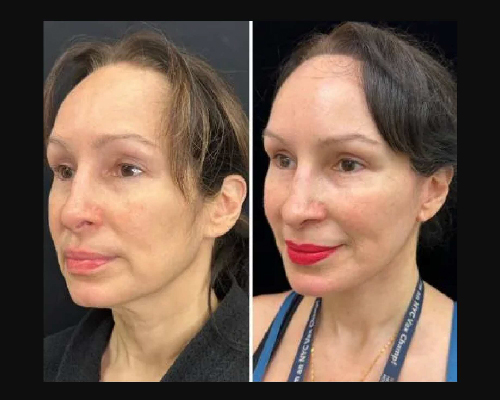 50-year-old Female Awake Facelift Before and After Photos