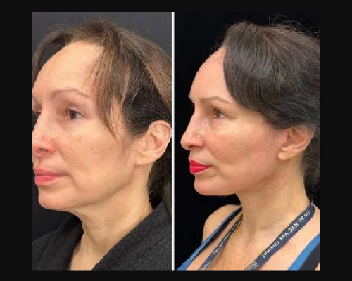 50-year-old Female Awake Facelift