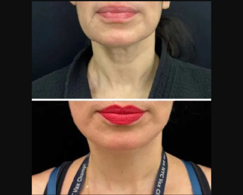 50-year-old Female Awake Facelift Neck View