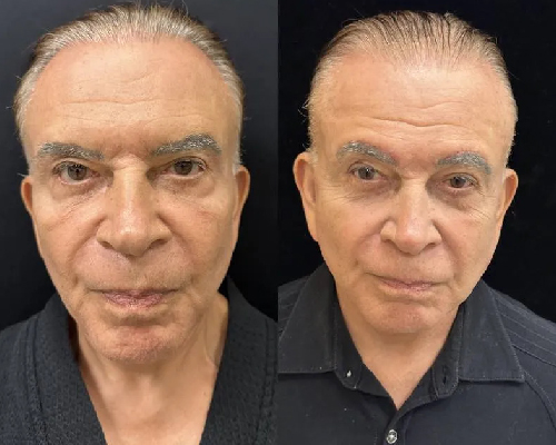 75-year-old male Deep Plane Facelift Photos NYC Front View