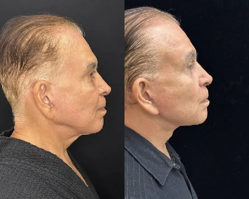 75-year-old male Deep Plane Facelift Photos NYC