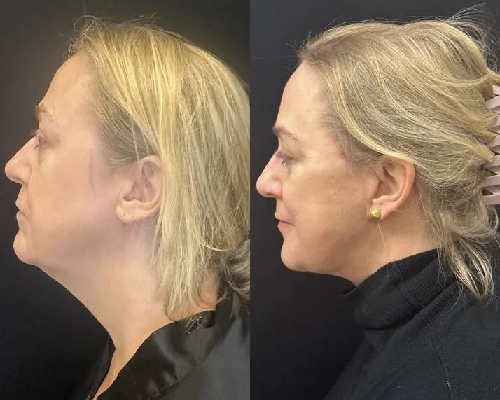 3 Months Postop Deep Plane Facelift New York City